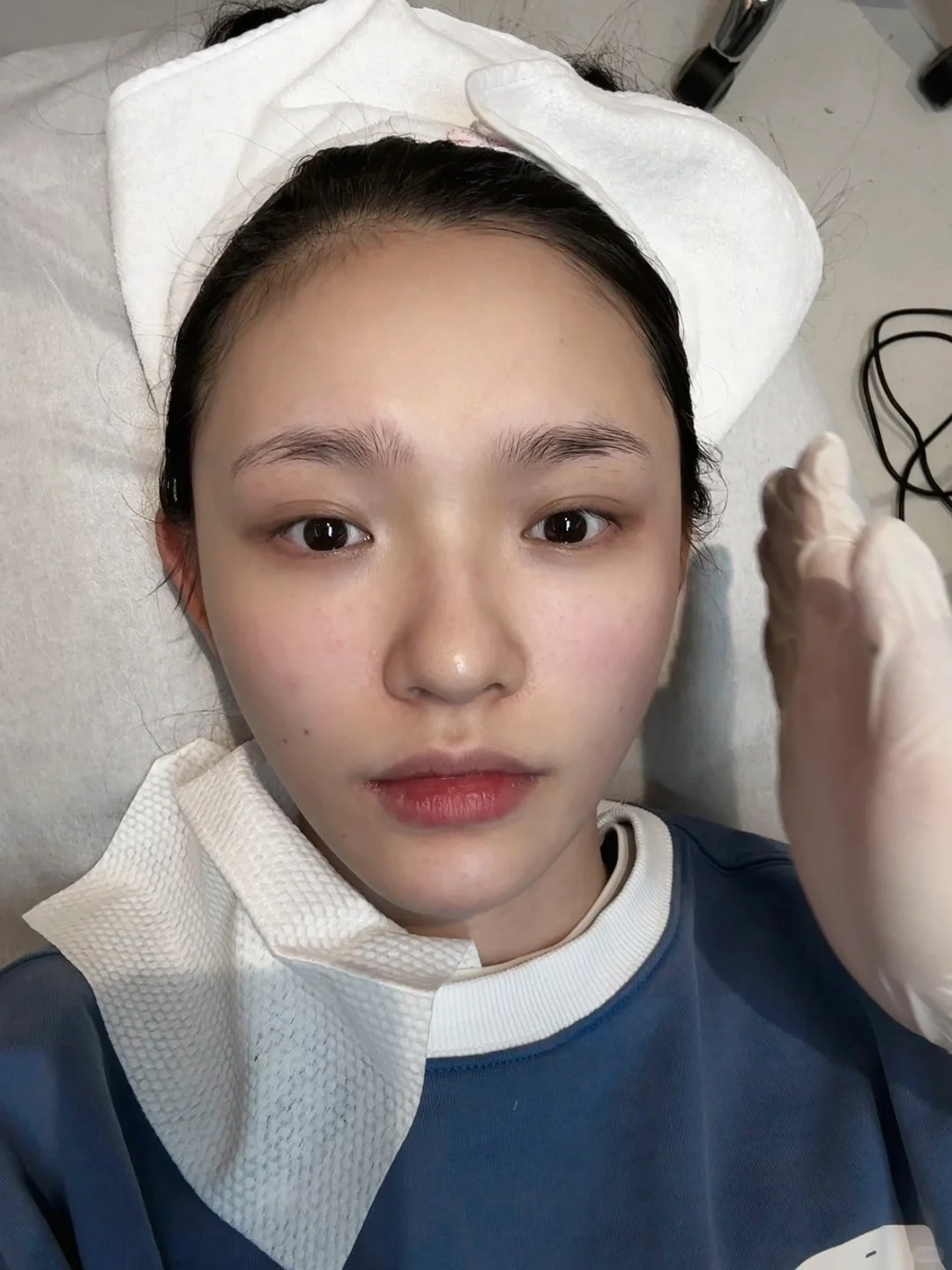 右邊臉部剛做完超聲炮,對比左邊,臉部提拉效果非常明顯。