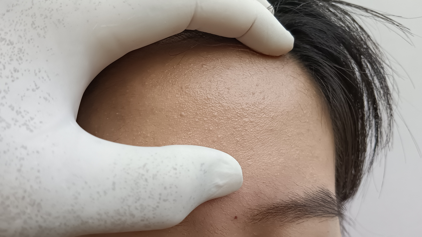 要安全有效地去暗粒和去油脂粒,首先要了解自己的「粒粒」屬於哪種,再選擇合適的額頭暗粒處理方式。