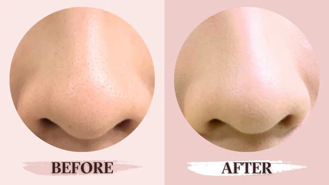 能有效吸附毛孔中堵塞的油脂和粉刺,溫和地解決毛孔粉刺問題。