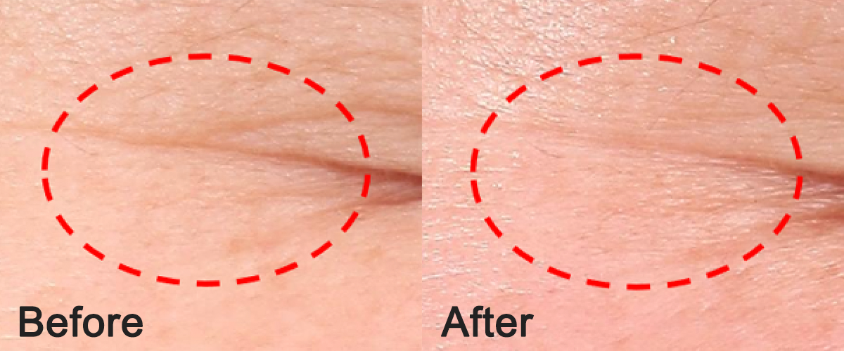 用後可見魚尾紋減淡，膚質更細滑。