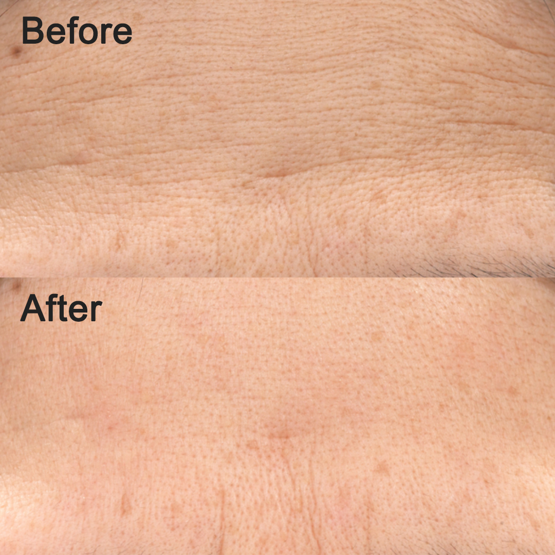 凹陷位像被重新Pump起般，紋理被撫平了不少，效果有驚喜！