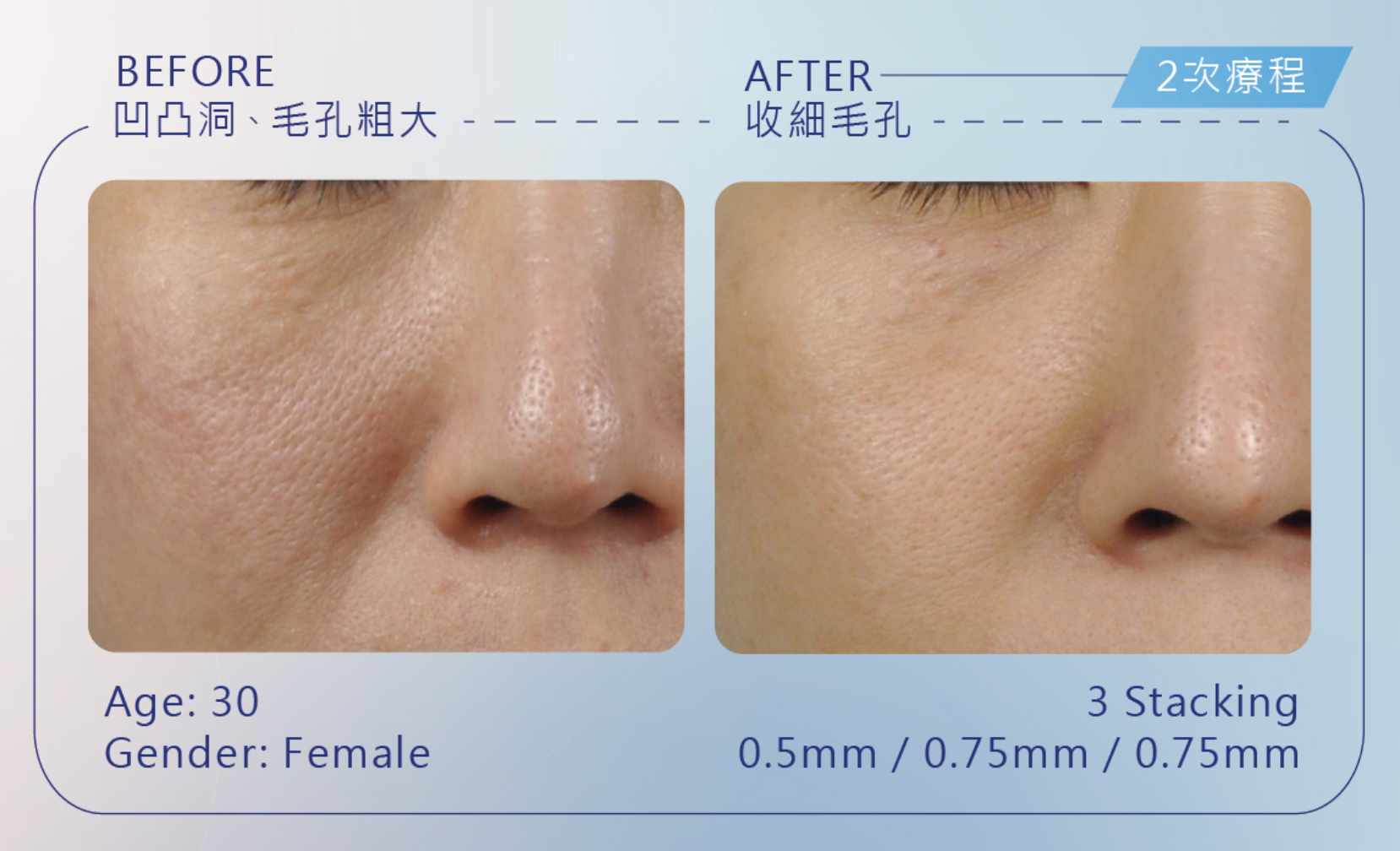 完全2次療程後，可看到整體膚質明顯得到改善。