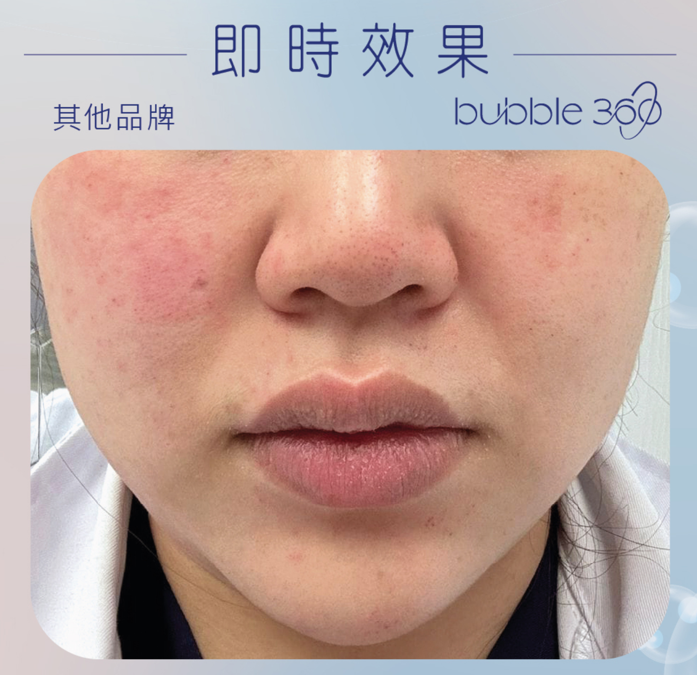 療程後只有些許微紅，但很快就消退了，而且也沒有疼痛感。