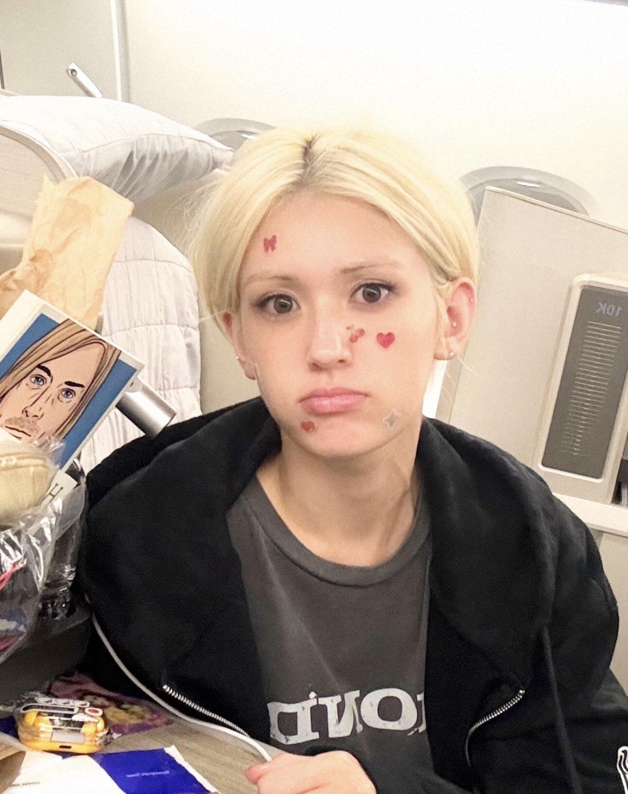 錯誤的擠壓只會導致發炎加劇，甚至留下長久的暗瘡印