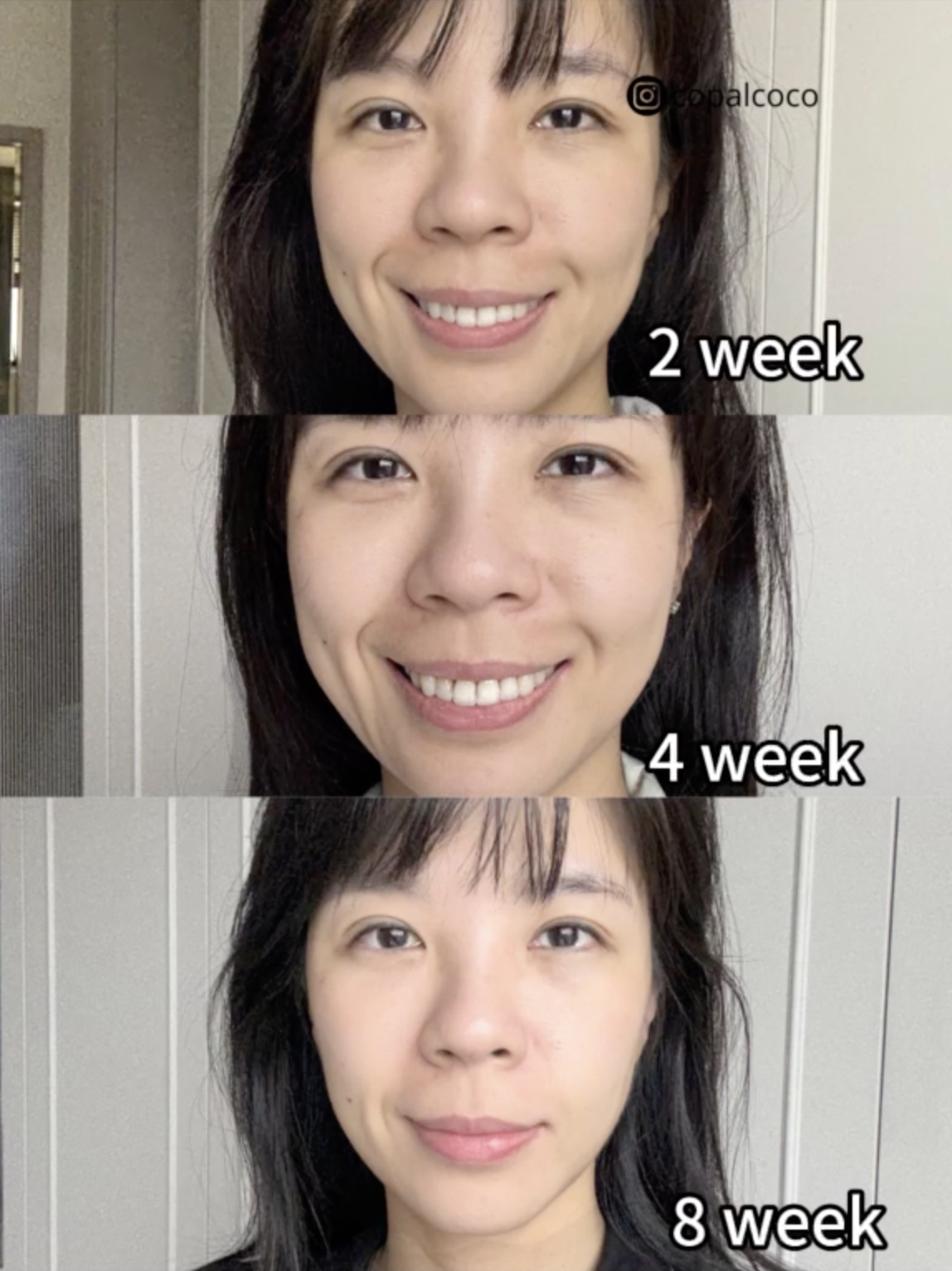 Coco用了2星期、4星期及8星期，明顯看見色斑變得更淺，整體膚色也更透白。