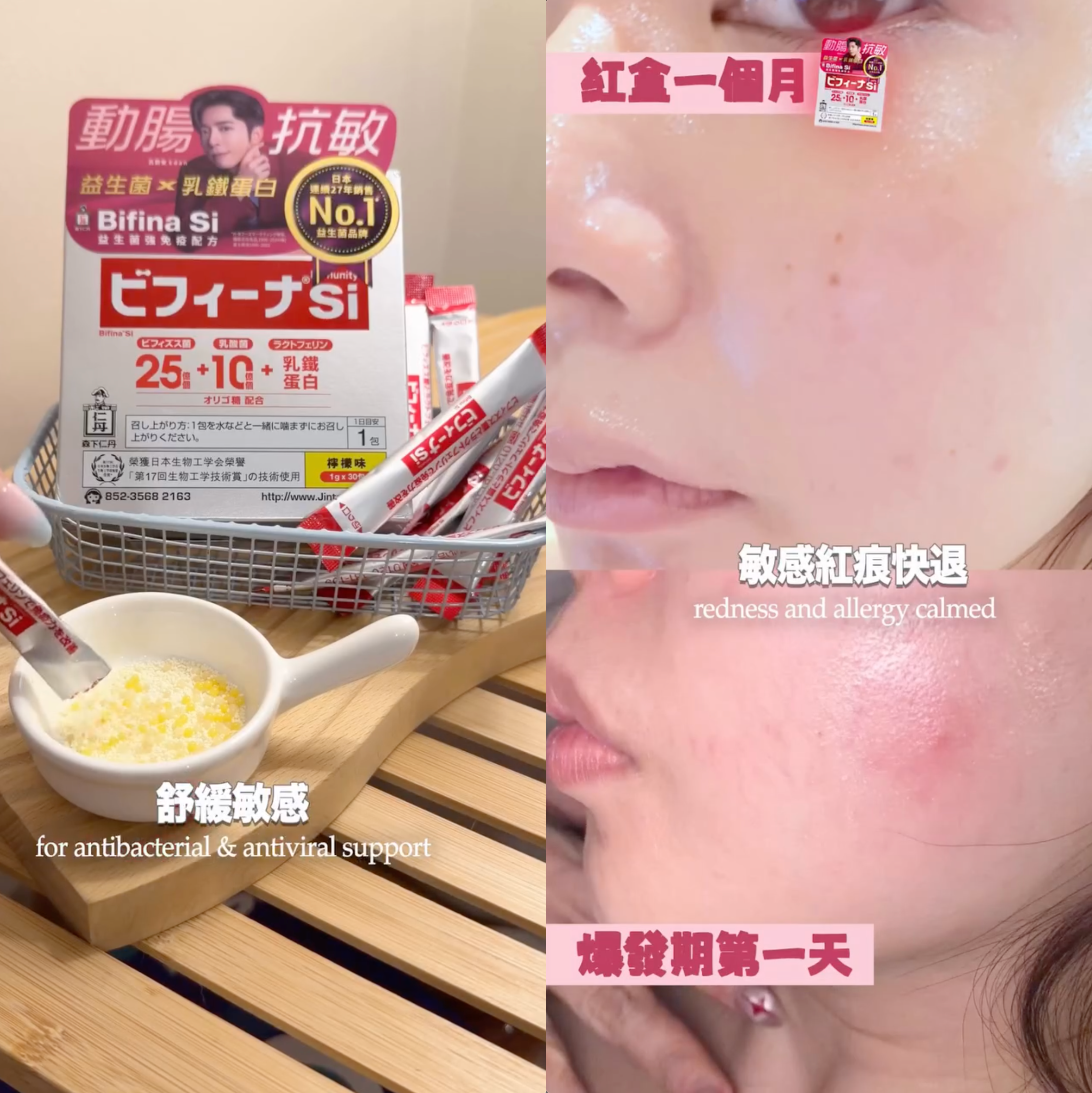 真實用家ah veee分享以前濕敏發作時紅、腫痕癢，用了強免疫配方一個月敏感紅痕已明顯改善。