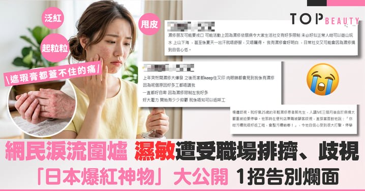 遮瑕膏都蓋不住的痛！網民淚流圍爐，濕敏遭受職場排擠、歧視，「日本爆紅神物」大公開1招告別爛面！